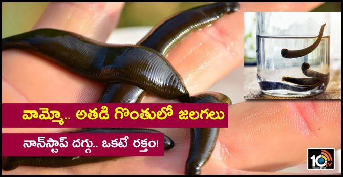 Man Coughing Non-Stop For 2 Months Had Live Leeches Stuck To Throat